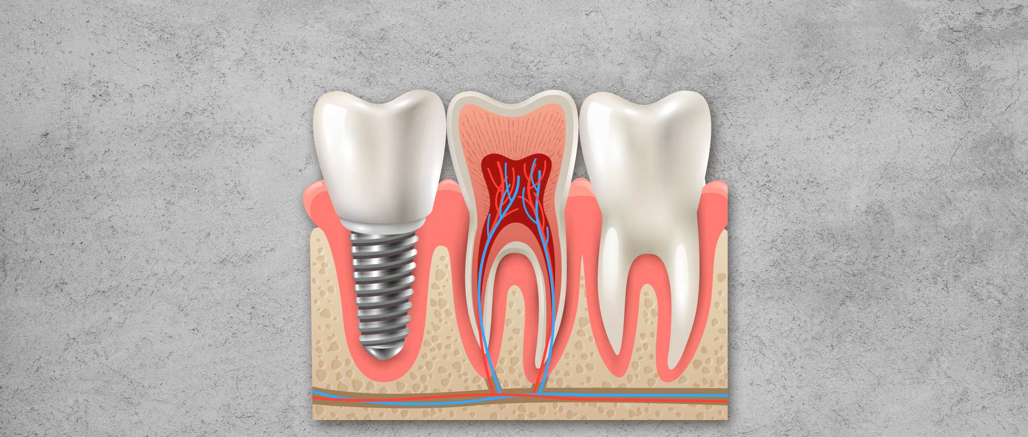 Zahnimplantate / Weisheitszähne
